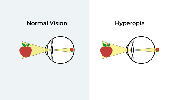 What Is Hyperopia? (Long-sightedness)