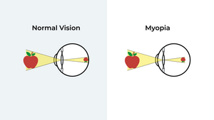 What Is Myopia? (Short Sightedness)